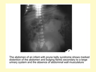 The abdomen of an infant with prune belly syndrome shows marked
distention of the abdomen and bulging flanks secondary to a large
urinary system and the absence of abdominal wall musculature
 