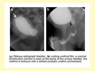 (a) Oblique radiograph bladder, (b) voiding urethral film, a urachal
diverticulum (arrow) is seen at the dome of the urinary bladder, the
urethra is tortuous with a dilated prostatic urethra (arrowhead)
 