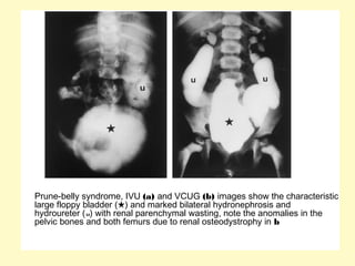 Prune-belly syndrome, IVU (a) and VCUG (b) images show the characteristic
large floppy bladder (★) and marked bilateral hydronephrosis and
hydroureter (u) with renal parenchymal wasting, note the anomalies in the
pelvic bones and both femurs due to renal osteodystrophy in b
 