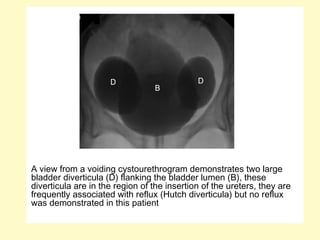 A view from a voiding cystourethrogram demonstrates two large
bladder diverticula (D) flanking the bladder lumen (B), these
diverticula are in the region of the insertion of the ureters, they are
frequently associated with reflux (Hutch diverticula) but no reflux
was demonstrated in this patient
 