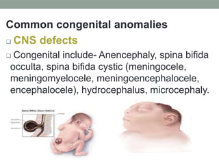 Common congenital anomalies
 CNS defects
 Congenital include- Anencephaly, spina bifida
occulta, spina bifida cystic (meningocele,
meningomyelocele, meningoencephalocele,
encephalocele), hydrocephalus, microcephaly.
 