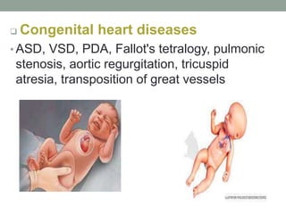  Congenital heart diseases
• ASD, VSD, PDA, Fallot's tetralogy, pulmonic
stenosis, aortic regurgitation, tricuspid
atresia, transposition of great vessels
 