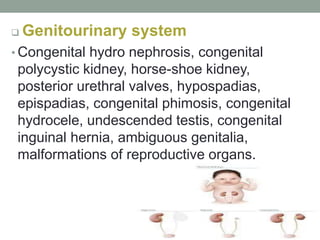 Genitourinary system
• Congenital hydro nephrosis, congenital
polycystic kidney, horse-shoe kidney,
posterior urethral valves, hypospadias,
epispadias, congenital phimosis, congenital
hydrocele, undescended testis, congenital
inguinal hernia, ambiguous genitalia,
malformations of reproductive organs.
 