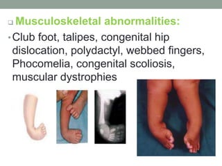  Musculoskeletal abnormalities:
•Club foot, talipes, congenital hip
dislocation, polydactyl, webbed fingers,
Phocomelia, congenital scoliosis,
muscular dystrophies
 
