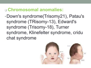  Chromosomal anomalies:
•Down's syndrome(Trisomy21), Patau's
syndrome (TRisomy-13), Edward's
syndrome (Trisomy-18), Turner
syndrome, Klinefelter syndrome, cridu
chat syndrome
 