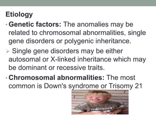 Etiology
• Genetic factors: The anomalies may be
related to chromosomal abnormalities, single
gene disorders or polygenic inheritance.
 Single gene disorders may be either
autosomal or X-linked inheritance which may
be dominant or recessive traits.
• Chromosomal abnormalities: The most
common is Down's syndrome or Trisomy 21
 