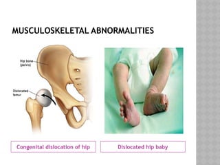 Genetic Dislocation CONGENITAL ANOMALIES.pptx there are certain types of congenital ...