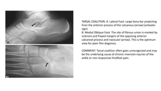 Button Sign Navicular CONGENITAL ANOMALIES ANDNORMAL SKELETAL VARIENTS.pptx a.pptx final ppt.pptx