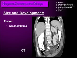 Renal Rotation Radiology Congenital anomalies ii | PPT