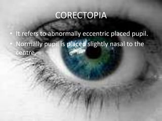 Congenital anomalies in the eye | PPTX