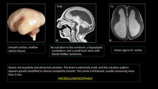 Congenital anomalies of brain radiology 2.pptx