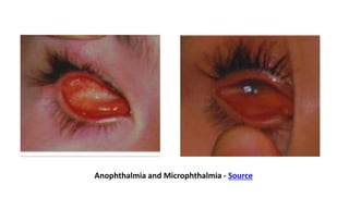 Congenital Anomalies of Eyelids and Orbit Dr. Prabhat Devkota.pptx