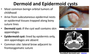 Congenital Anomalies of Eyelids and Orbit Dr. Prabhat Devkota.pptx