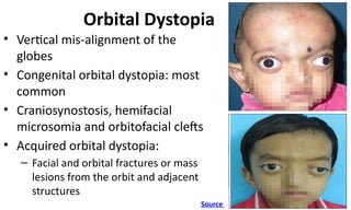 Vertical Distopia Congenital Anomalies of Eyelids and Orbit | PPTX