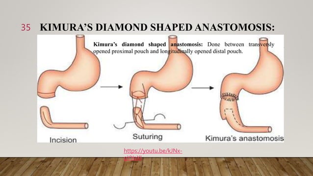 congenital anomalies of intestine ppt.pptx