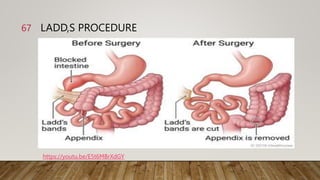 Congenital Anomalies Of Intestine Ppt pptx Congenital Anomalies Of Intestine Ppt pptx