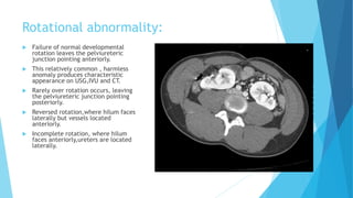 Congenital Anomalies of Kidney bt dr. shahariar | PPTX
