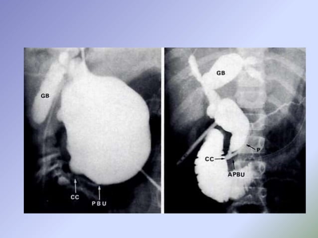Apbj Radiology Congenital Anomalies Of Pancreas And Hepatobiliary System Radiology ...