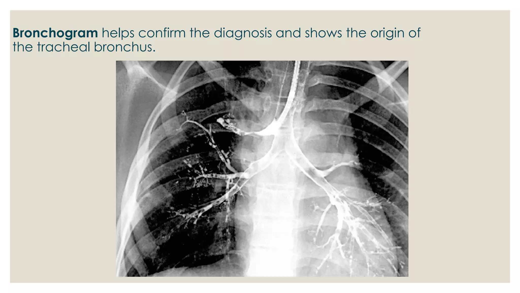 Congenital anomalies of respiratory system A Radiological approach | PDF