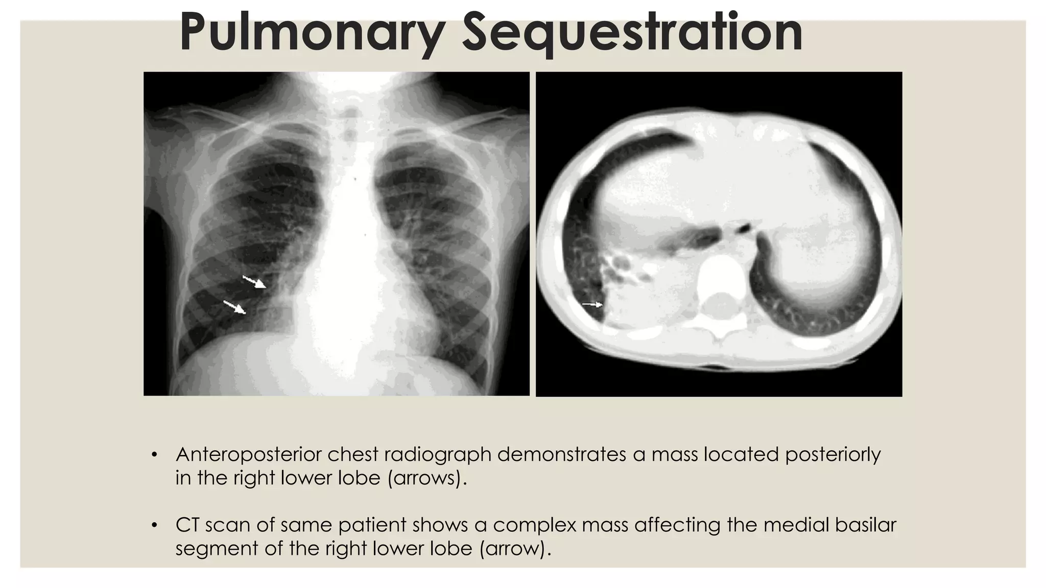 Congenital anomalies of respiratory system A Radiological approach | PDF