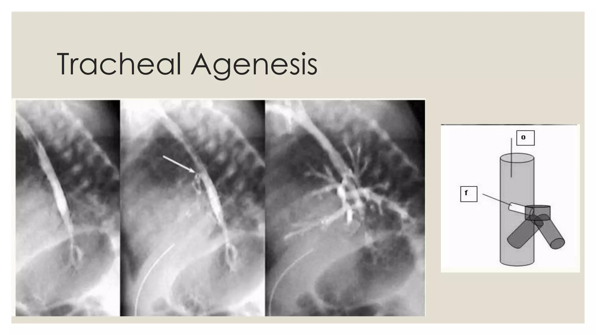 Congenital anomalies of respiratory system A Radiological approach | PDF