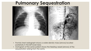 Congenital anomalies of respiratory system A Radiological approach | PDF