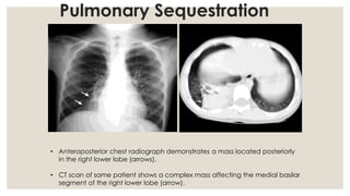 Congenital anomalies of respiratory system A Radiological approach | PDF