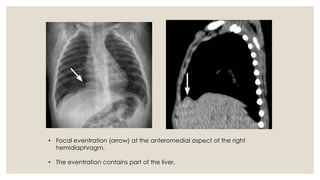 Eventration Index Calculation Congenital anomalies of respiratory system A Radiological approach | PDF