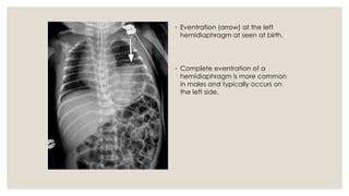 Eventrated Congenital anomalies of respiratory system A Radiological approach | PDF