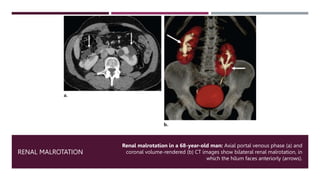 Kidney Rotation Congenital Anomalies of the Kidney & Urinary Tract | PPTX
