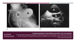 Congenital Anomalies of the Kidney & Urinary Tract | PPTX