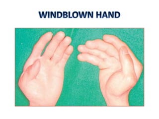 One Finger Missing Congenital anomalies of upper limb | PPTX