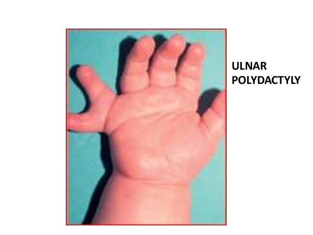 Congenital anomalies of upper limb