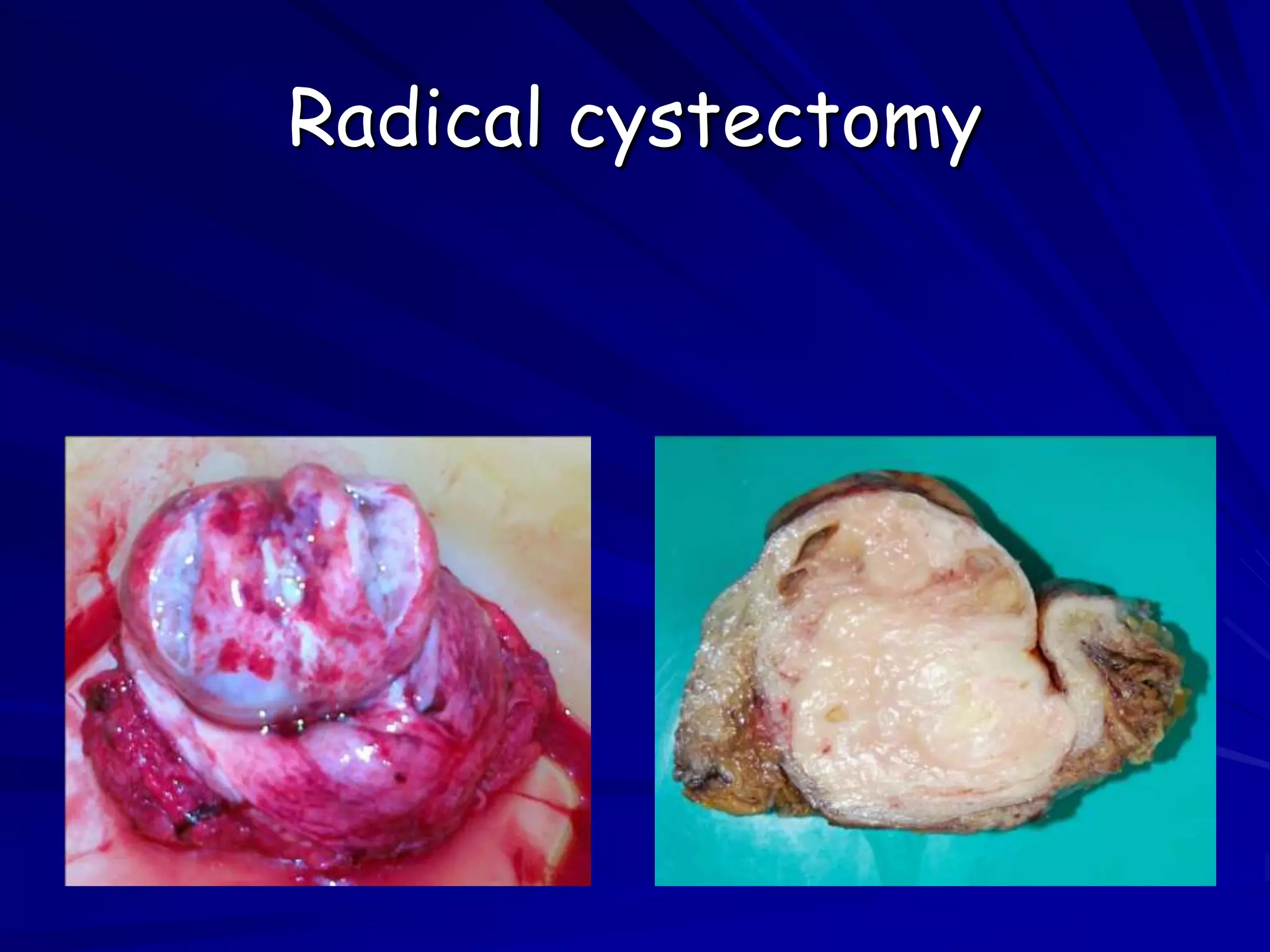 Radical cystectomy
 