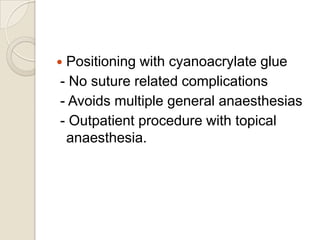 Positioning with cyanoacrylate glue
- No suture related complications
- Avoids multiple general anaesthesias
- Outpatient procedure with topical
anaesthesia.



 