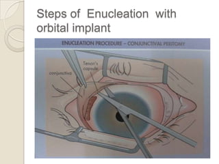 Steps of Enucleation with
orbital implant

 