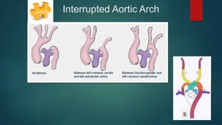 Congenital aortic diseases by MSCT | PDF