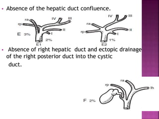 Drain Absence Congenital bile duct anomalies | PPTX