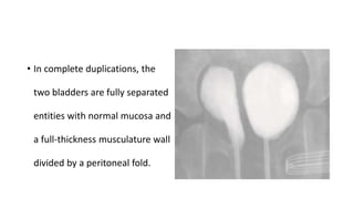 Congenital bladder disorders | PPTX