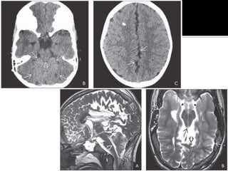 Congenital brain anomalies | PDF