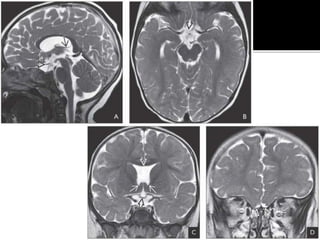 Congenital brain anomalies | PDF