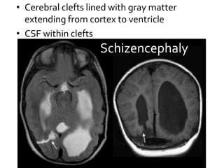 Congenital Brain Abnormalities