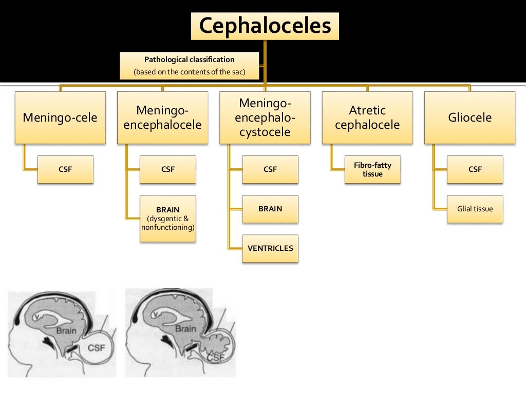 Congenital brain anomalies