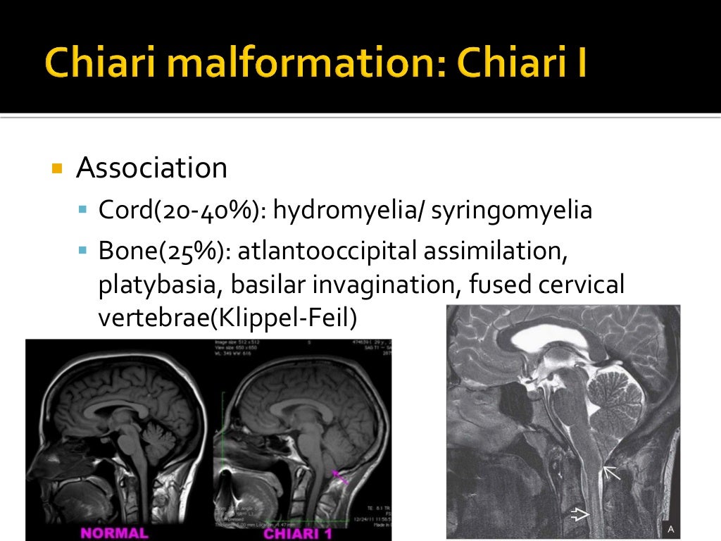 Congenital brain anomalies
