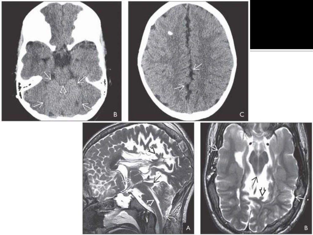 Congenital brain anomalies
