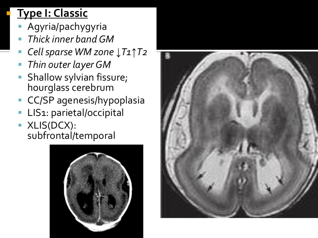 Congenital brain anomalies