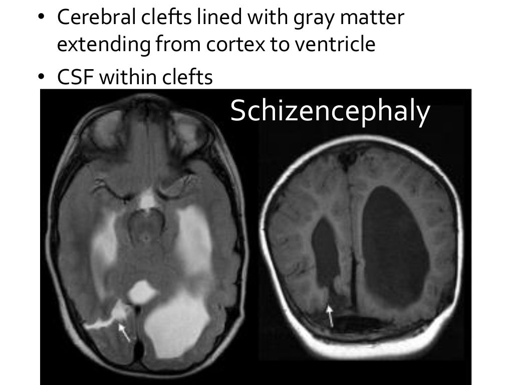 Congenital brain anomalies