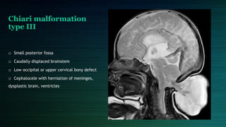 CONGENITAL BRAIN ANOMALIES for radiology.pptx