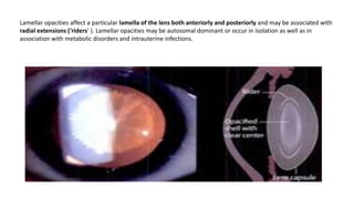 Lamellar opacities affect a particular lamella of the lens both anteriorly and posteriorly and may be associated with
radial extensions (‘riders’ ). Lamellar opacities may be autosomal dominant or occur in isolation as well as in
association with metabolic disorders and intrauterine infections.
 