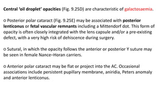 Central ‘oil droplet’ opacities (Fig. 9.25D) are characteristic of galactosaemia.
○ Posterior polar cataract (Fig. 9.25E) may be associated with posterior
lenticonus or fetal vascular remnants including a Mittendorf dot. This form of
opacity is often closely integrated with the lens capsule and/or a pre-existing
defect, with a very high risk of dehiscence during surgery.
○ Sutural, in which the opacity follows the anterior or posterior Y suture may
be seen in female Nance–Horan carriers.
○ Anterior polar cataract may be flat or project into the AC. Occasional
associations include persistent pupillary membrane, aniridia, Peters anomaly
and anterior lenticonus.
 